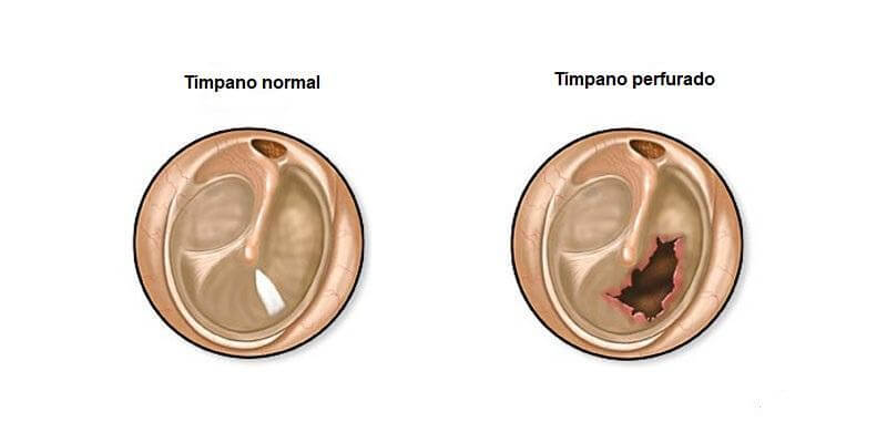 Diferenças entre um tímpano saudável e um tímpano perfurado